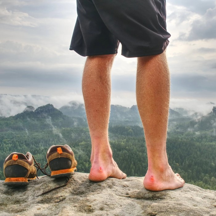 hiking blisters treatment