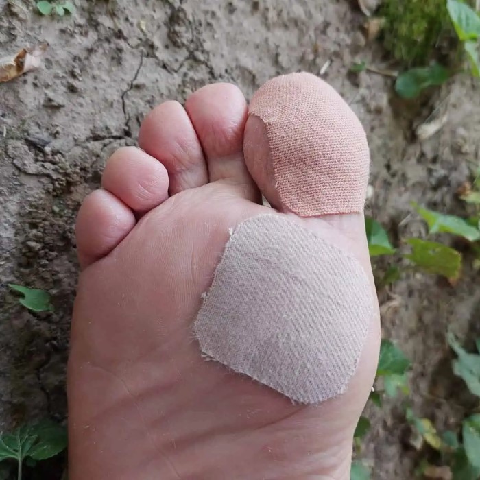 hiking blisters treatment