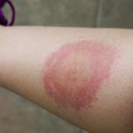 how many mosquito bites is dangerous