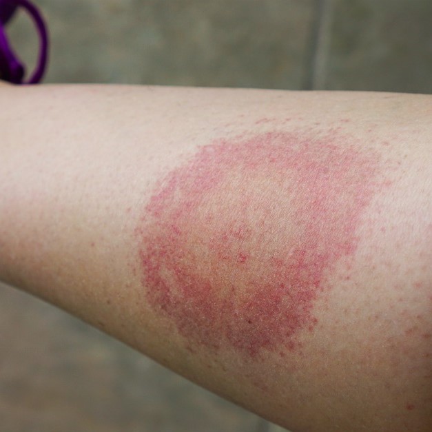 how many mosquito bites is dangerous