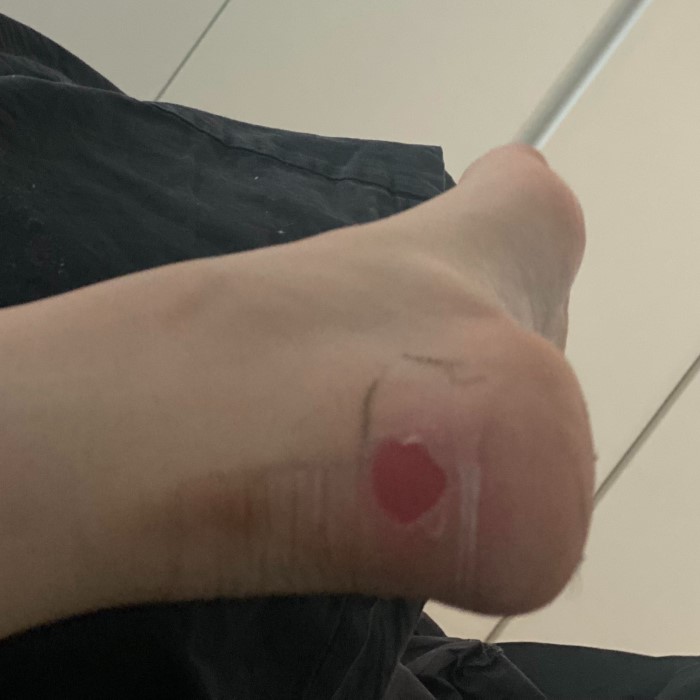 hiking blisters treatment